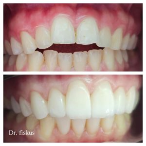 מנשך פתוח - ד"ר גלעד פיסקוס