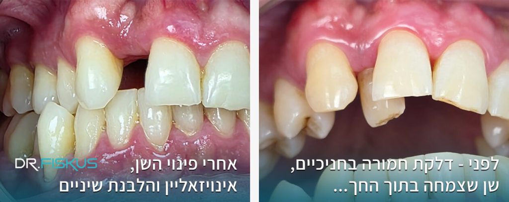דר' פיסקוס - השלמת שן חסרה ללא שתל - כתר מרילנד Emax