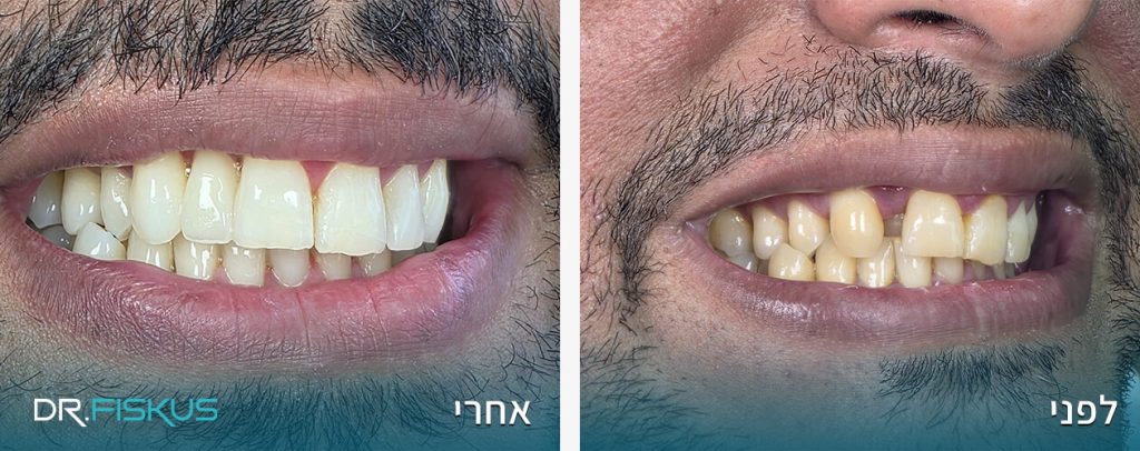 דר' פיסקוס - השלמת שן חסרה ללא שתל - כתר מרילנד Emax